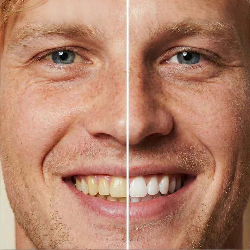 🦷 ACQUISTA 1 E NE OTTIENI 1 GRATIS! ✨ Vernice sbiancante istantanea per denti da 5 ml – Effetto rapido, sicura per lo smalto e facile da applicare 💎